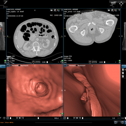 colon polyp detection